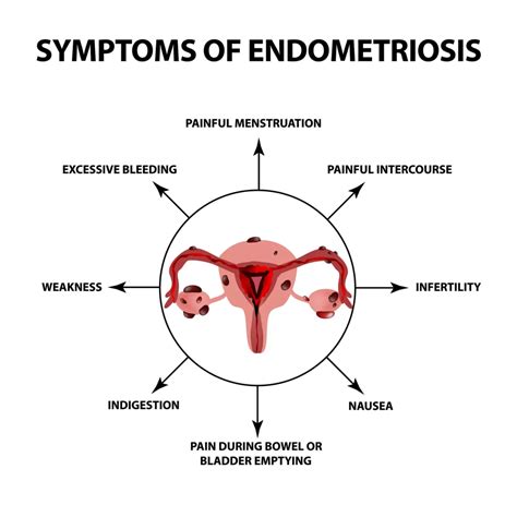 what were your endometriosis symptoms